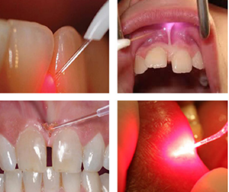 Berylas MultiWavelengths 810nm 980nm Dental Laser