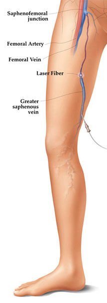 Leg Vein Treatment Endovenous Laser Therapy Endovascular Laser Ablation