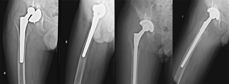 Orthopedic Titanium Artificial Joint Hip Prosthesis