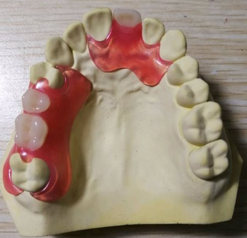 CADCAM Rubber 3D Printed Crowns Are Easy To Maintain And Fit