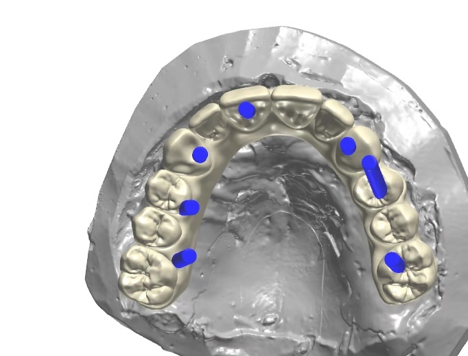 CADCAM Metal 3d Printing PFM Denture and False Teeth