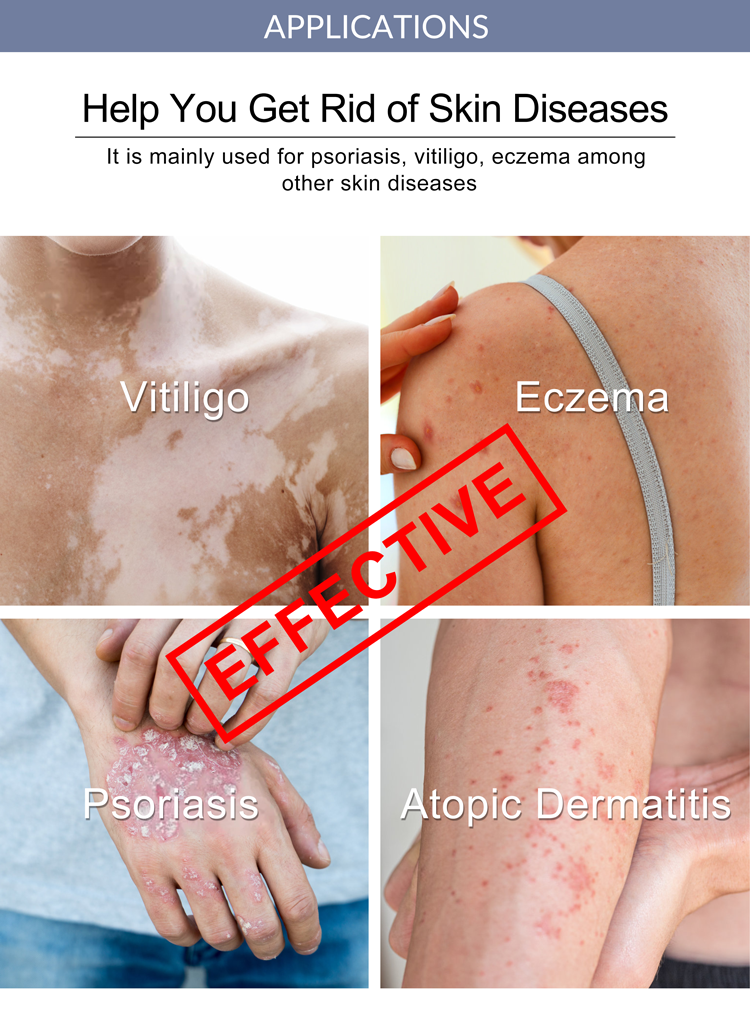 High costperformance effective laser excimer 308nm device for psoriasis vitiligo and eczema