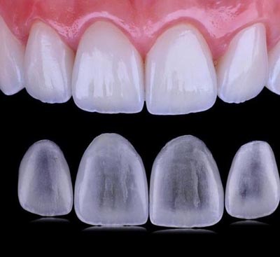 Veneers Dental Lab Crowns and Bridges