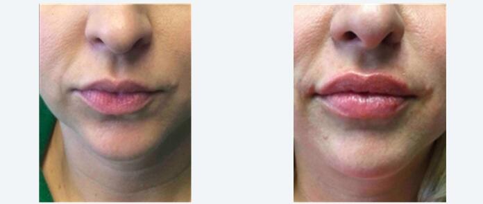 Cross Linked Hyaluronic Acid Injectable Dermal Filler to Buy for Lips