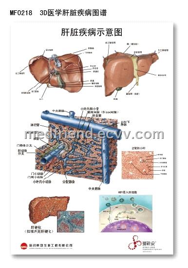 3d Medical Anatomical Pvc Chart Liver Disease From China Manufacturer Manufactory Factory And Supplier On Ecvv Com