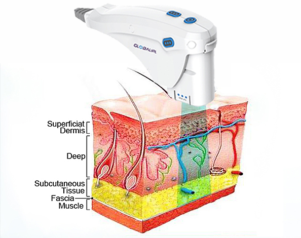 Aesthetics medical care HIFU face lifting skin tightening beauty machine