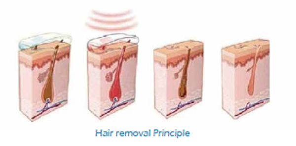 Multifunction IPL SHR system portable IPL Laser Hair Removal