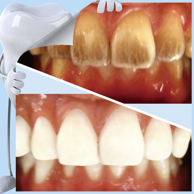Hot Items 2017 New Years Products Nano Teeth Whitening