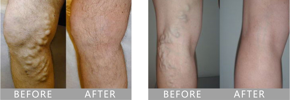 Endovenous laser therapy EVLT for Varicose veins