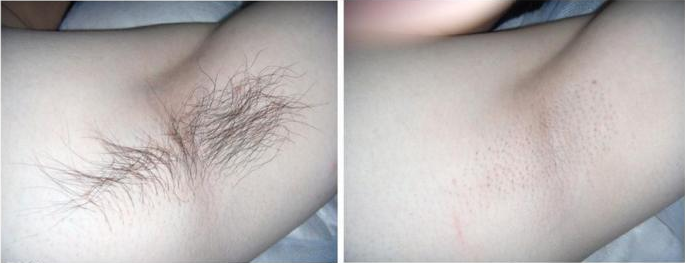 Shr IPL Permanent Hair Removal for Salon