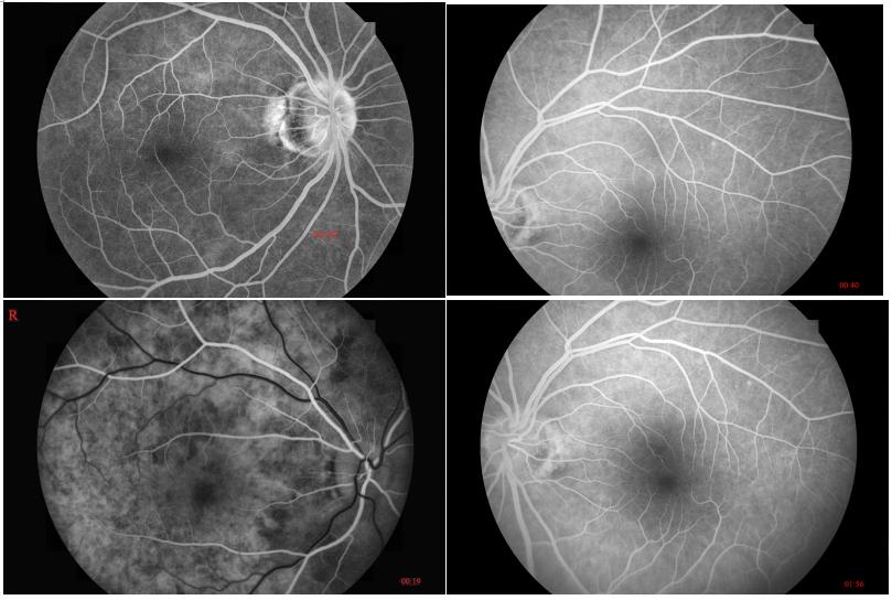 Ophthalmic Equipment Chinese Made Top Quality Digital Non Mydriatic Fundus Camera with Angiography FFA Mode