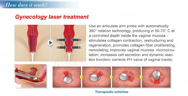 2017 fda approved skin rejuvenation tightening fractional spa equipment device rf co2 laser tube for salon and clinic