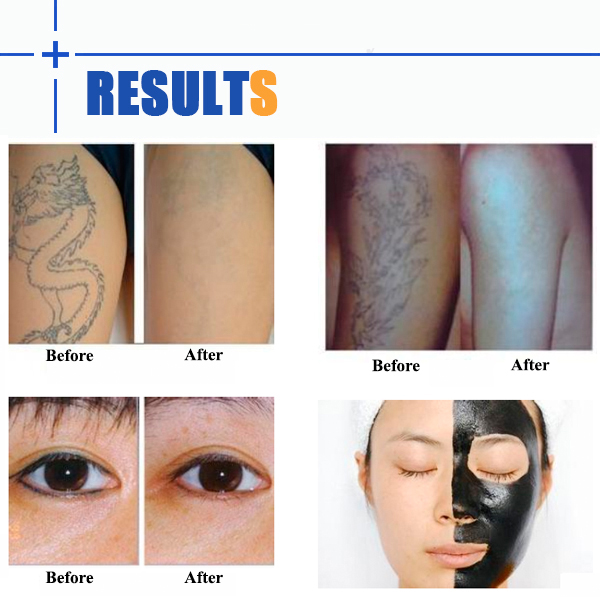 IPL opt hair removal laser tattoo removal machine