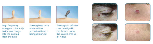 Factory Price Skin Tag Removal Machine
