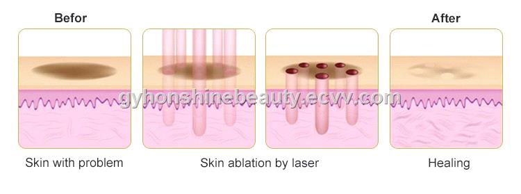 new designed RF tube scars removal facial renewing fractional CO2 laser