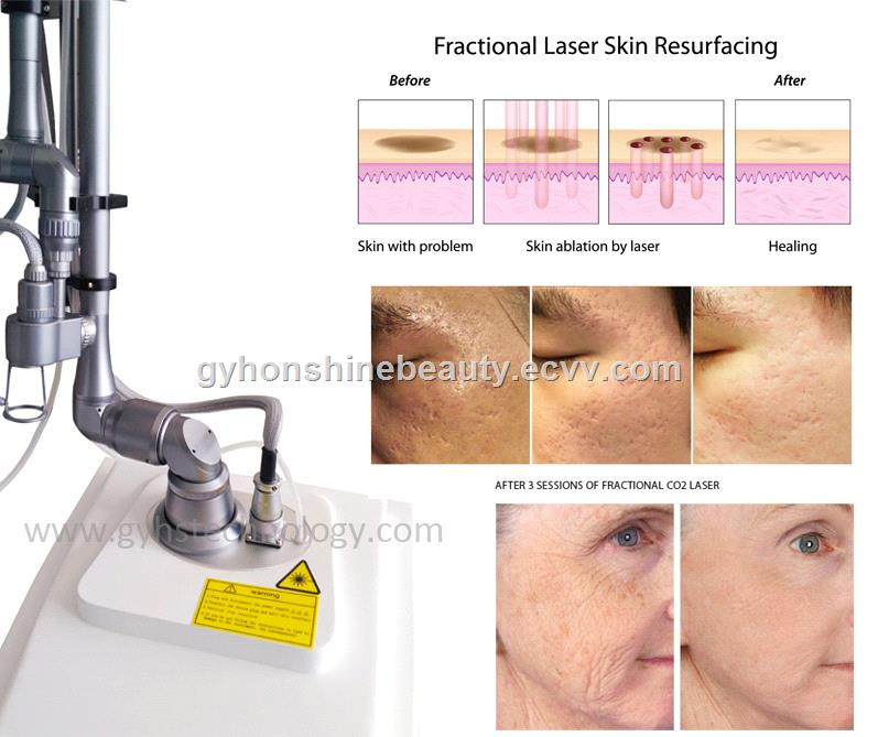 new designed RF tube scars removal facial renewing fractional CO2 laser