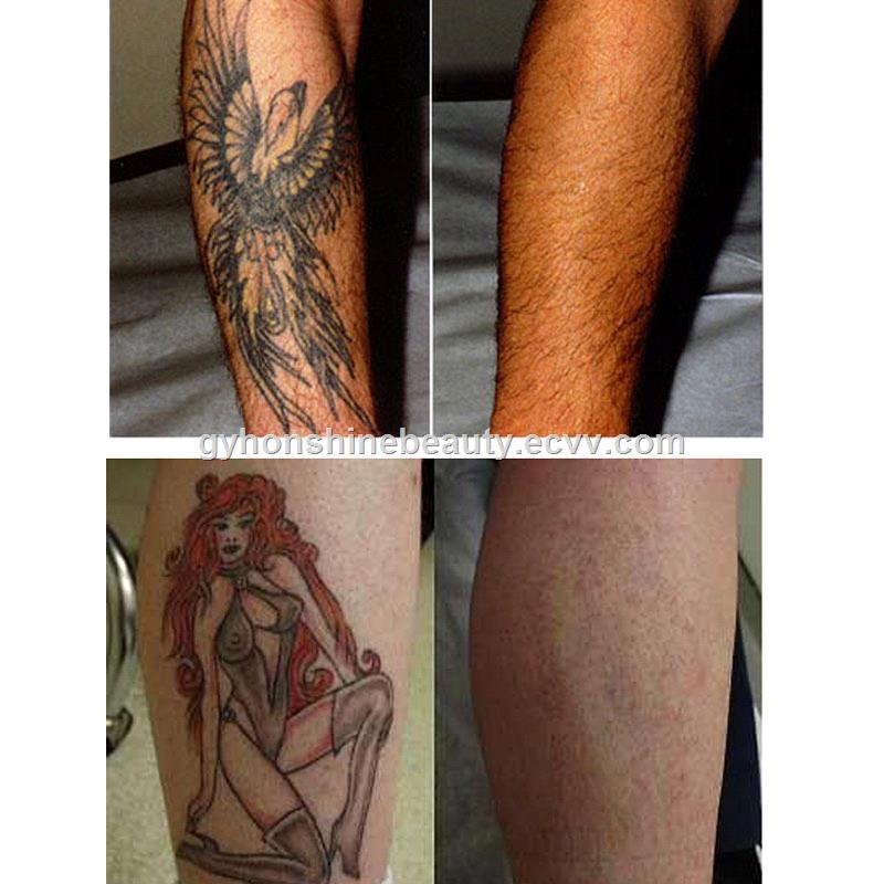 QSwitched Picosecond Laser nd Yag Tattoo Freckle Removal Pico Laser