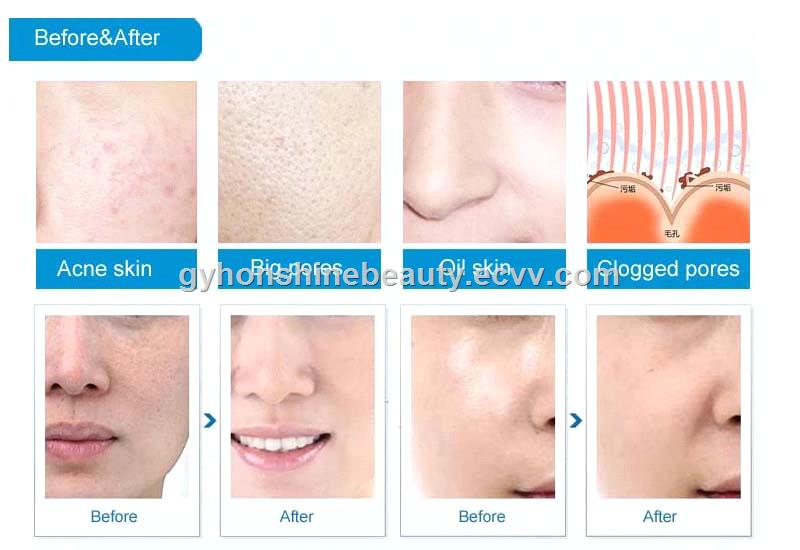 3 in 1 Hydro diamond tip microdermabrasion Facial machines