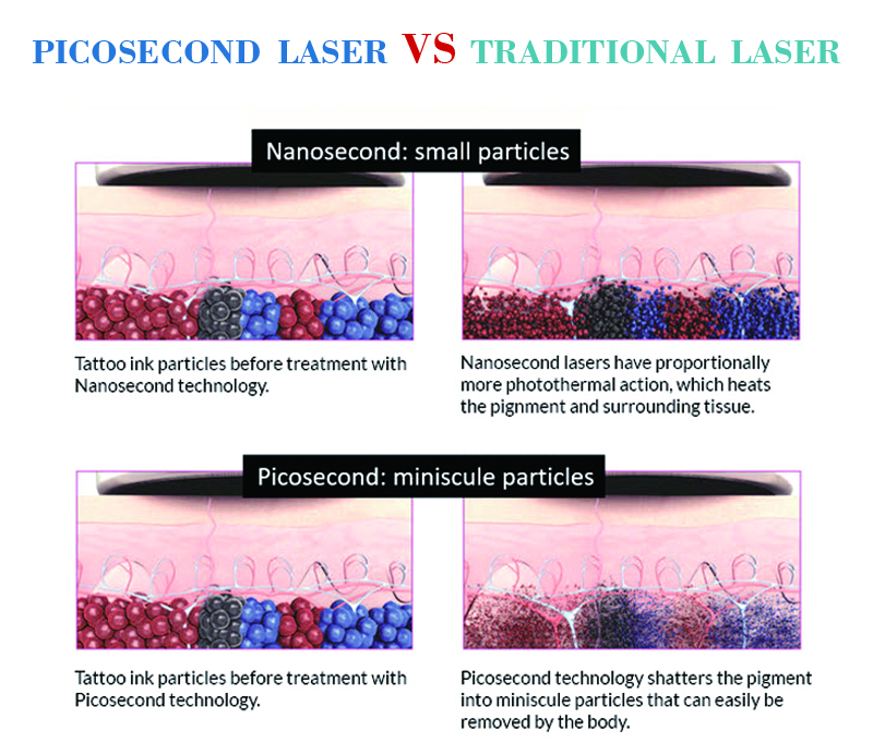 2018 most popular Picosecond laser CE approved machine pico laser for tattoo removal