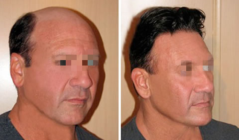 Lace in middle with thin skin around men hair replacement system