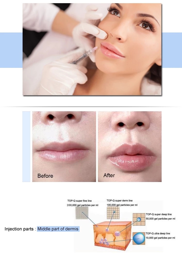 TOPQ Super Derm Line 2CC 100 hyaluronic acid dermal fillers for lip augmentation