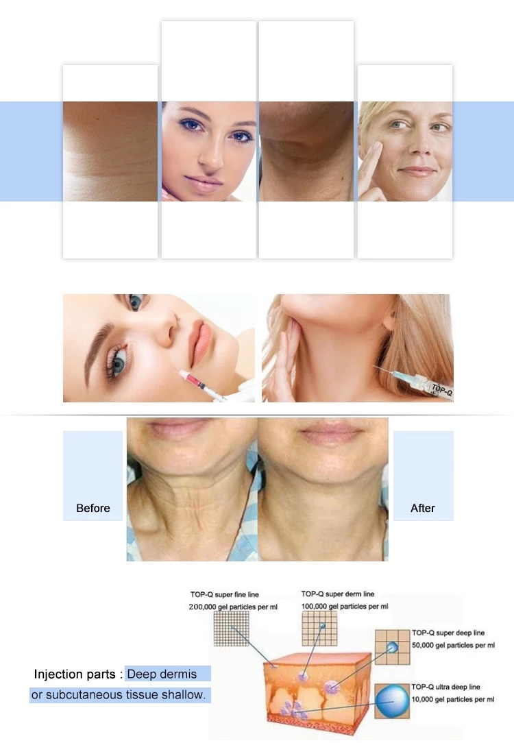 TopQ super ultra deep line 1ML antiaging cross linked hyaluronic acid filler injection for cheekbone