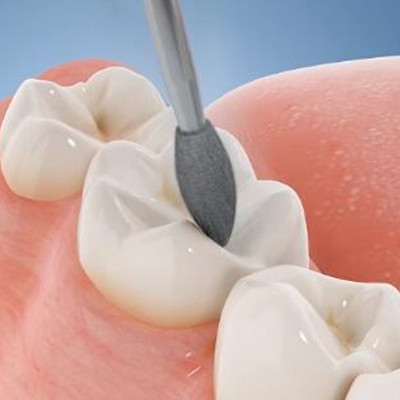 Dental Diamond Burs for precise drilling