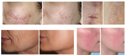 HF807 CO2 Fractional Laser beauty machine