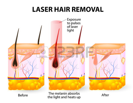 800W Diode Laser Hair Removal HF502D