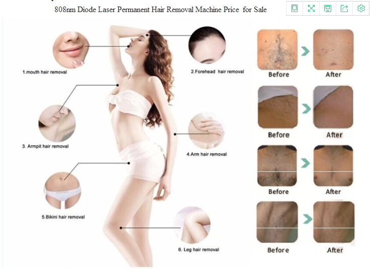 Highly Recommended 810nm Diode Laser Hair Removal