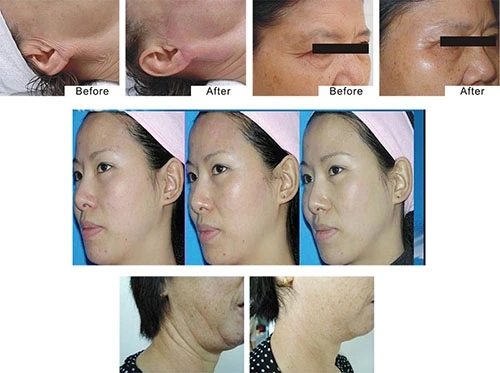 Hf203 RF Skin Tightening System