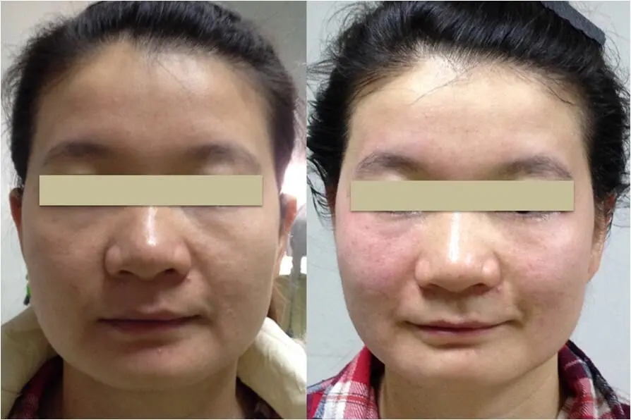 RF Skin Tightening Face Lifting Wrinkle Removal Beauty Machine