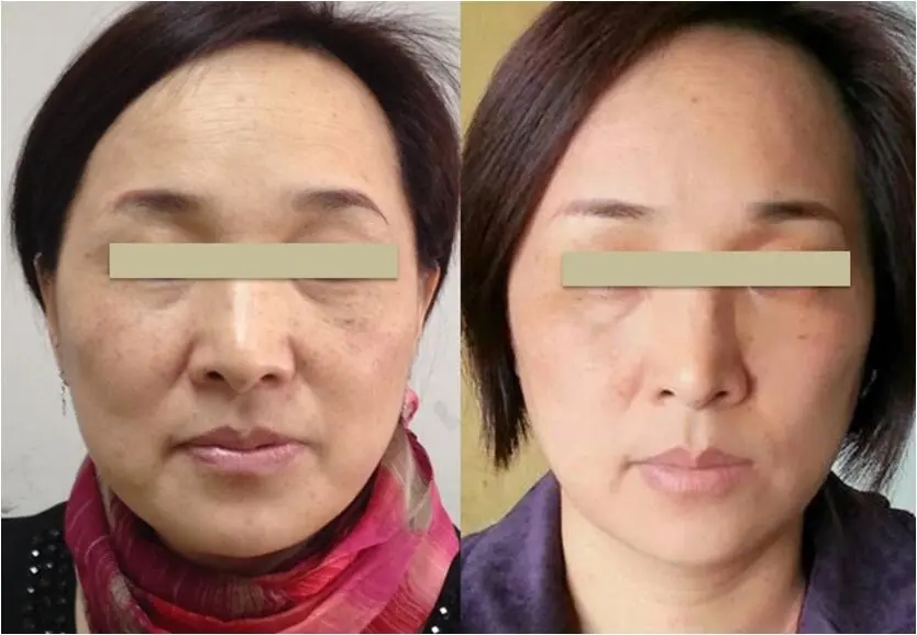 RF Skin Tightening Face Lifting Wrinkle Removal Beauty Machine
