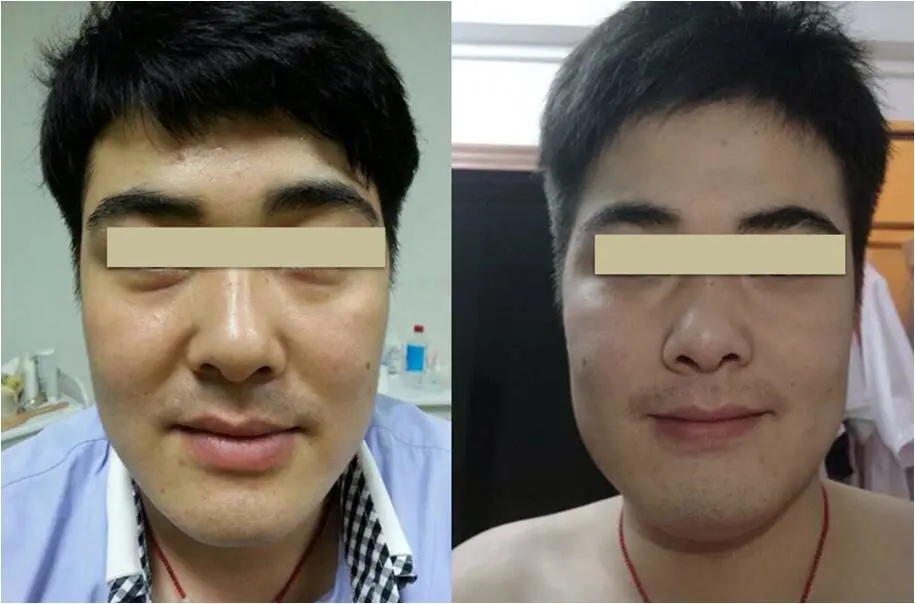 RF Skin Tightening Face Lifting Wrinkle Removal Beauty Machine