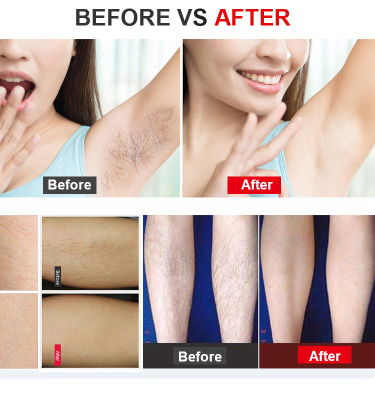 Permanent IPL Epilator Laser Hair Removal System Manual IPL Machine Repair Device For Women