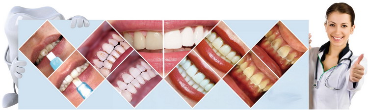Innovative Teeth Whitening kits shareusmile teeth cleaning kit