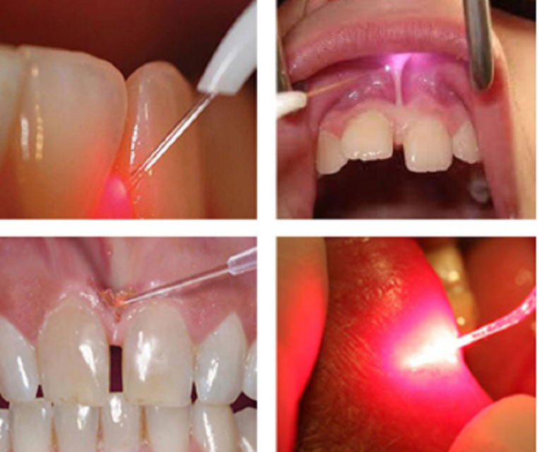 Dimed Berylas SingleWavelength DualWavelengths Dental Soft Tissue Laser