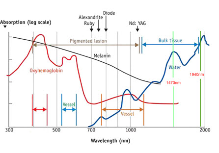 Cherylas 1940nm Endovenous Laser Ablation For Treating Endovenous Veins