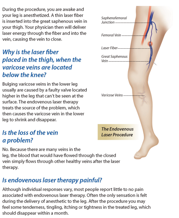 EVLT Endovenous laser treatment 1470nm980nm laser for minimaly invisave treatment