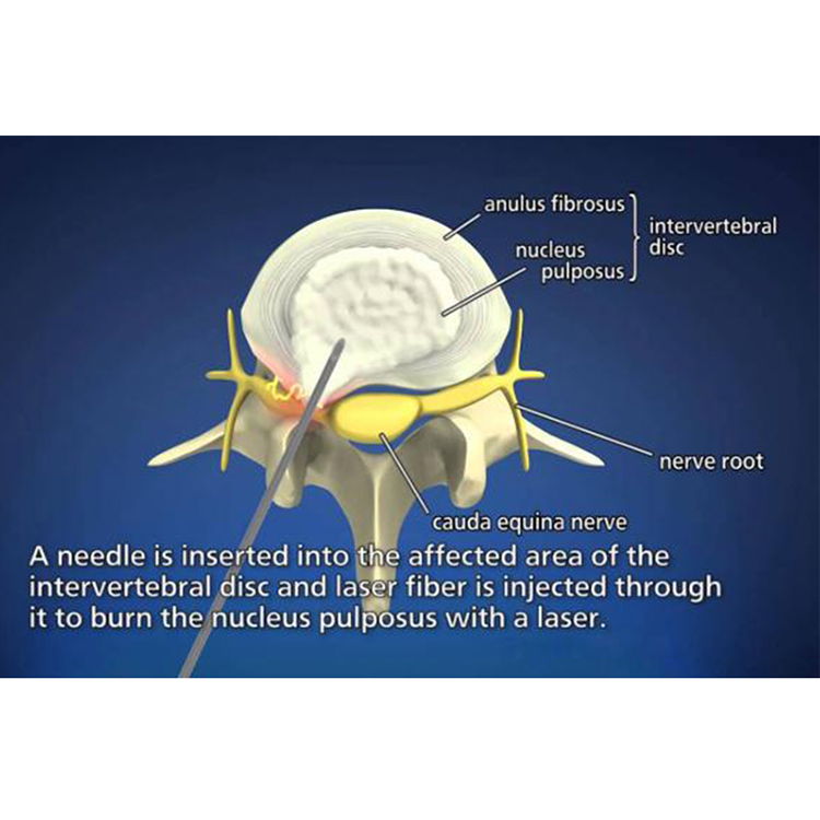 Cherylas Diode PLDD Laser Percutaneous Laser Disc Decompression 980nm