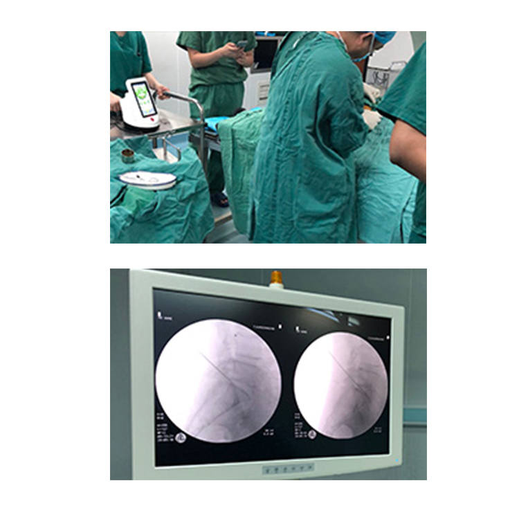 New clinical treatment diode fiber percutaneous laser disc decompression