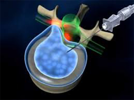 New clinical treatment diode fiber percutaneous laser disc decompression