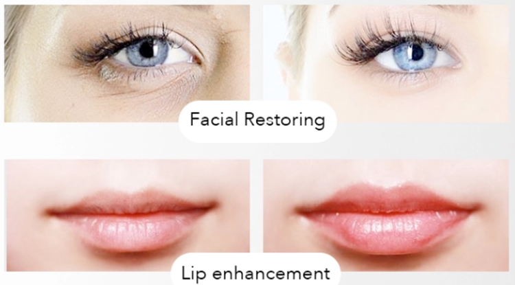 Deep 2ml Injectable Hyaluronic Acid Dermal Filler