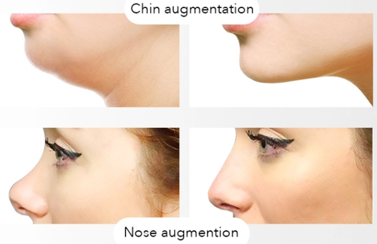 Deep 2ml Injectable Hyaluronic Acid Dermal Filler