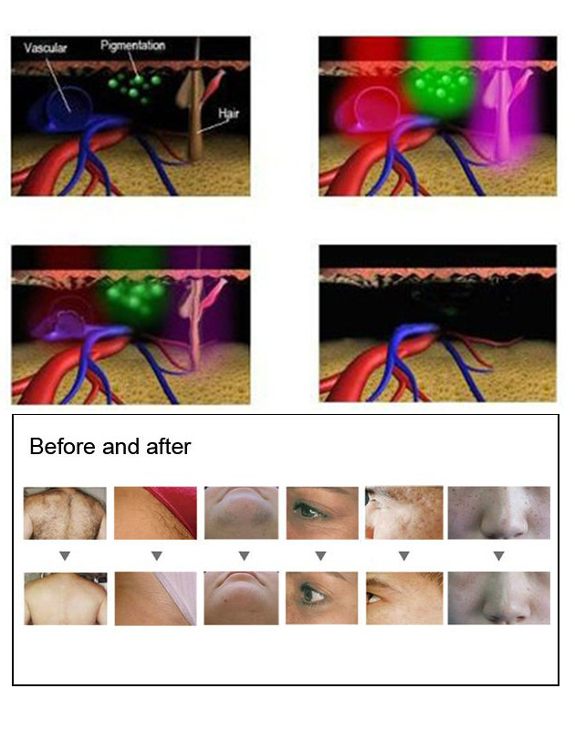 Lasy Laser 3 IN1 Multifunctional Beauty Device TattooHair Removal Laser Shr Ipl Salon Equipment