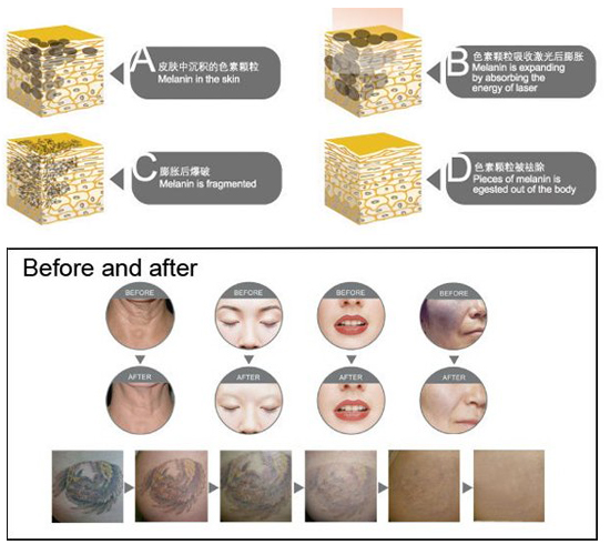 Lasy Laser 3 IN1 Multifunctional Beauty Device TattooHair Removal Laser Shr IPL Salon Equipment