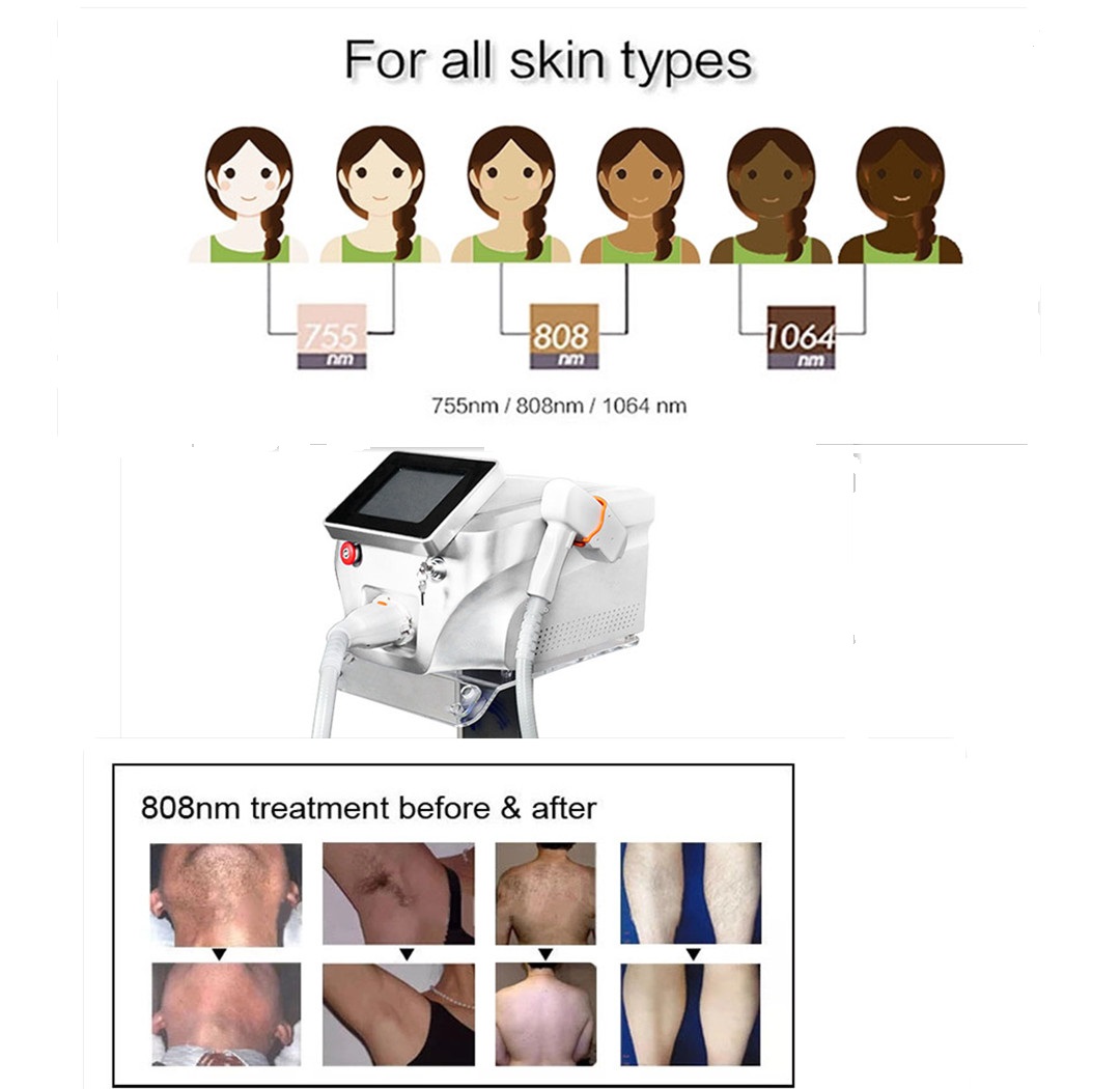 Profrssional 3 diode Wavelength Diode Laser 7558081064nm Laser Ice Xl Hair Removal Price