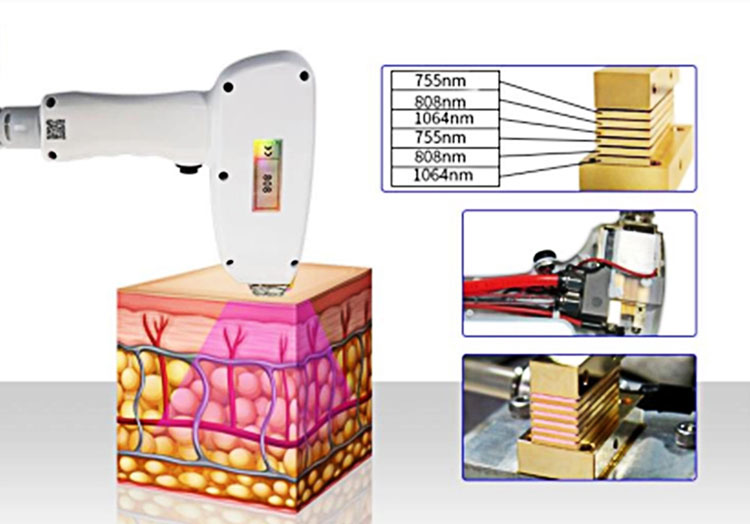 Profrssional 3 diode Wavelength Diode Laser 7558081064nm Laser Ice Xl Hair Removal Price