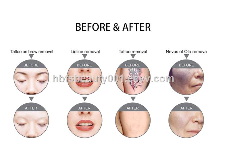 2022 new model best quality ND YAG laser Q switch YAG machine picosecond laser tattoo removal device
