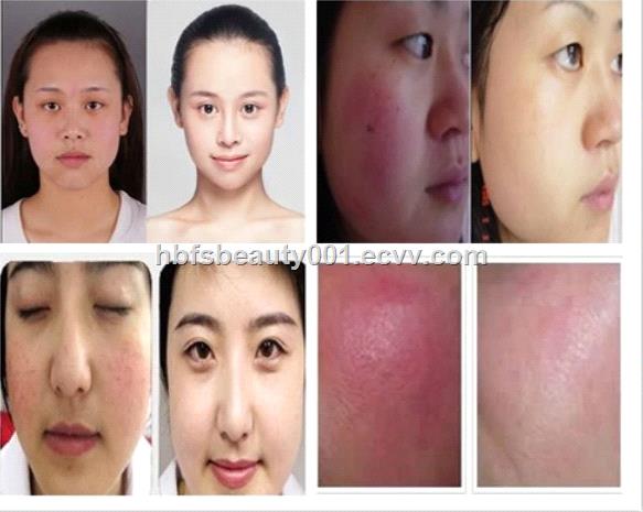CE Certificated Spider Vein Remove Machine Treatment Nail Fungus Onychomycosis Laser Treatment